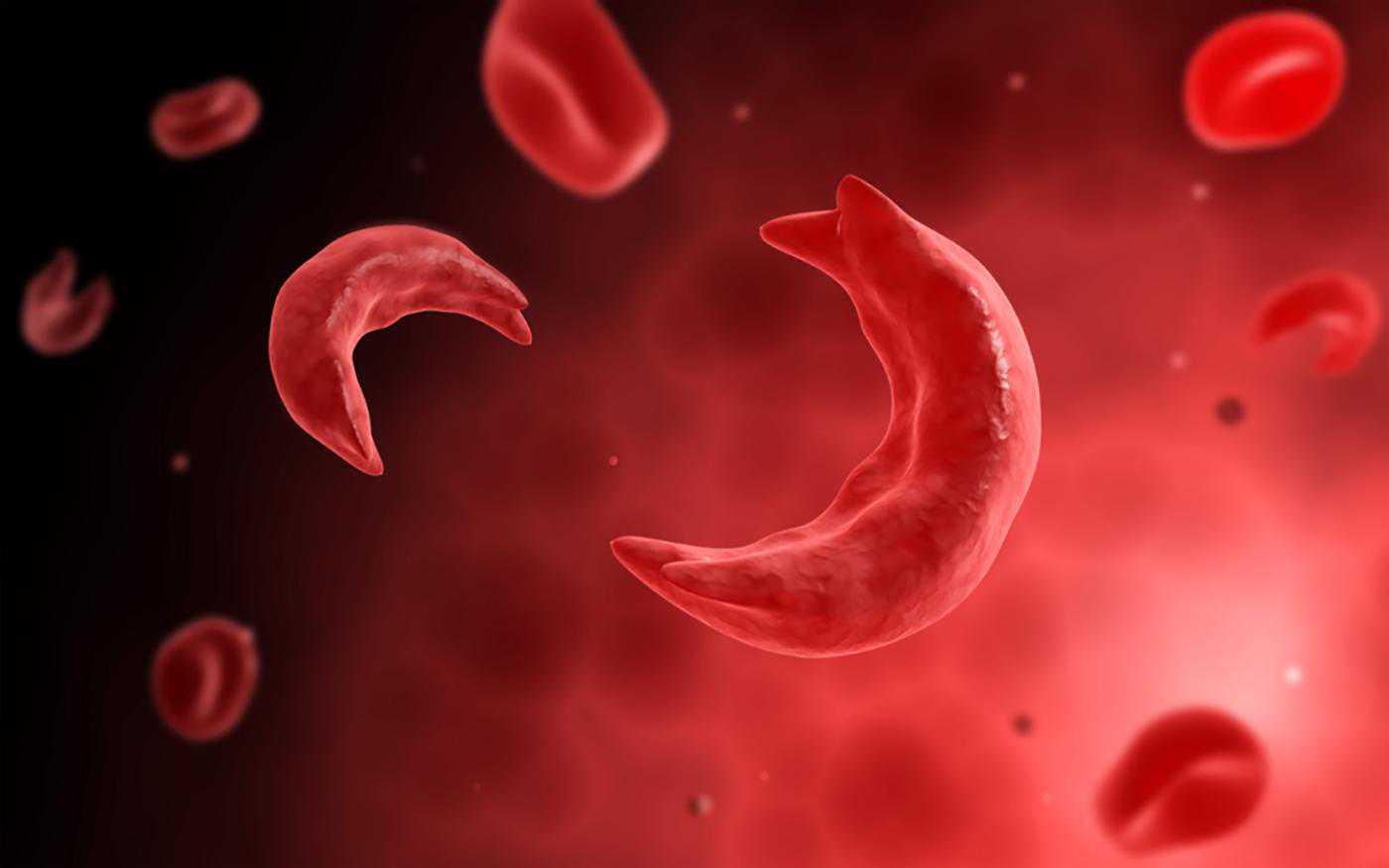 镰刀型细胞贫血，一种常染色体显性遗传病，主要见于非洲黑人